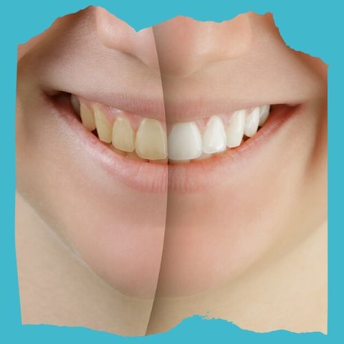 Zoom tooth whitening